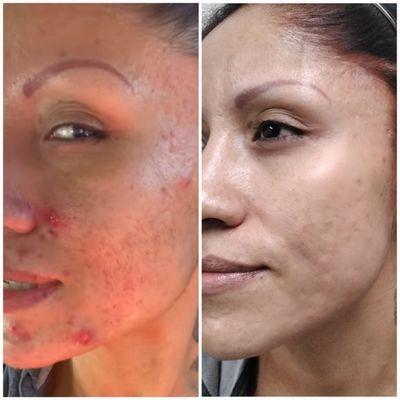 Microneedling + PRP treatment to improve acne scars