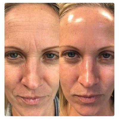 Hydrafacial Before & After