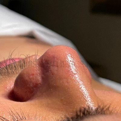 men's facial, nose after extractions