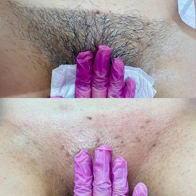 Brazilian wax