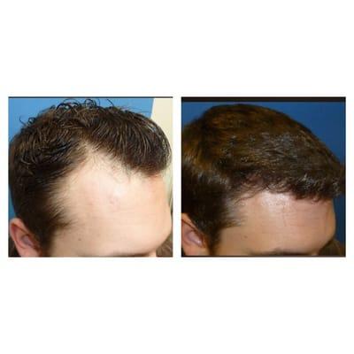 1500 grafts using FUE hair transplant technique