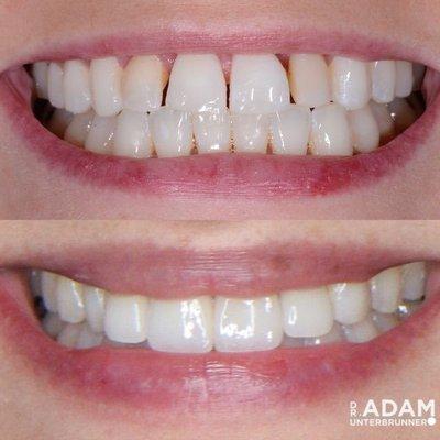 With four veneers and whitening Dr. Adam Unterbrunner  changed this patients smile forever!