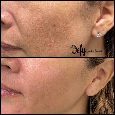 PicoSure Laser results after 2nd treatment with patient with melasma.