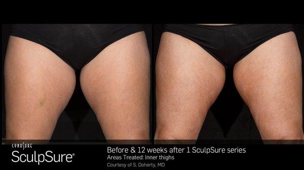 You can do SculpSure on any body area below the neck. Here is an example of SculpSure treatment on inner thighs. It only took one session!