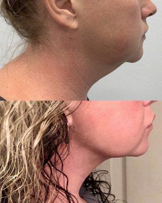 Before and after FaceTite treatment performed by Dr. Jeremy Timmer