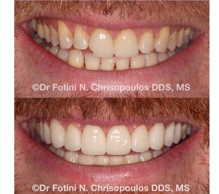 Cosmetic Veneers by Dr C- his new smile reflects his personality and facial features!