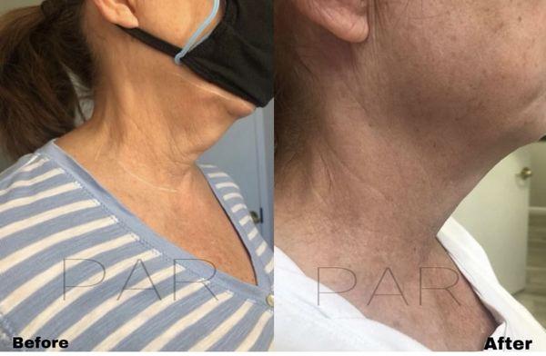 Fibroblast Plasma Skin Tightening