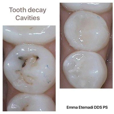 Treating Children and Adults with tooth decay