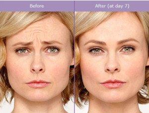 Botox- Before & Afters