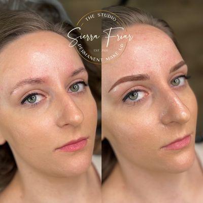 Combo Brow Correction