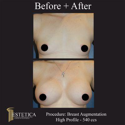 A great before and 6 months post op of a breast augmentation!