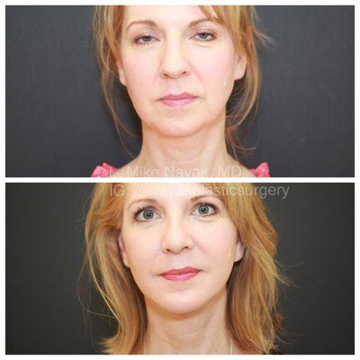 6 weeks post Deep Necklift, Deep Plane Facelift, Rhinoplasty, Buccal Fat Removal and Chin Implant