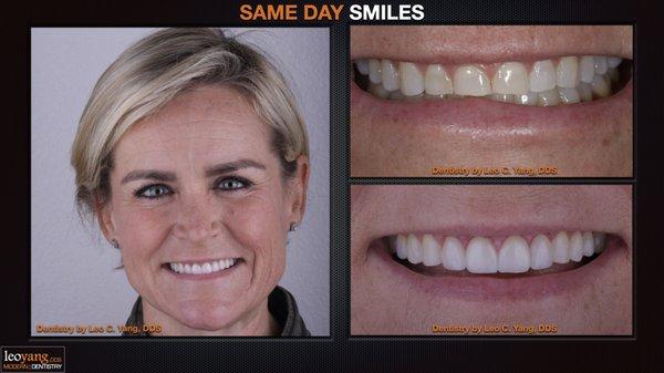 Bridgette had worn front teeth for a long time.  Look what natural looking veneers can change a smile.  She is now smiling with confidence!