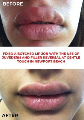 Fixed a botched lip job with the use of Juvederm and filler reversal.