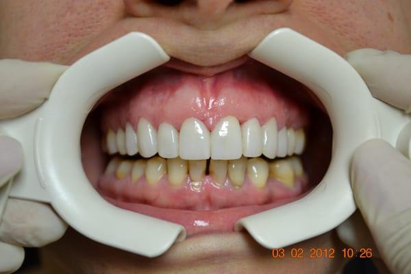 Porcelain Veneers After 1