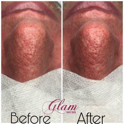 Deep Pore Acne Facial w/Extractions Before and After