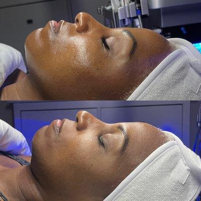 Immediate Results from ONE Deluxe Hydrafacial Treatment with a Hydro Jelly Add-On