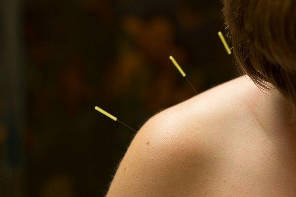 Acupuncture for pain management