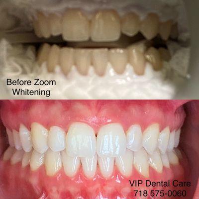 Zoom Teeth Whitening @vipdentalcare