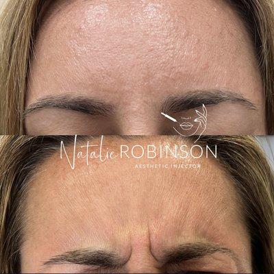 Xeomin Wrinkle Treatment