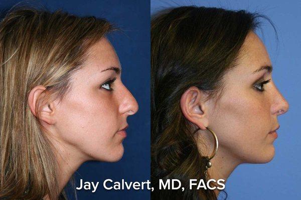 Rhinoplasty by Dr Jay Calvert