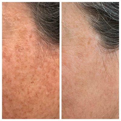 IPL for sunspots and hyperpigmentation