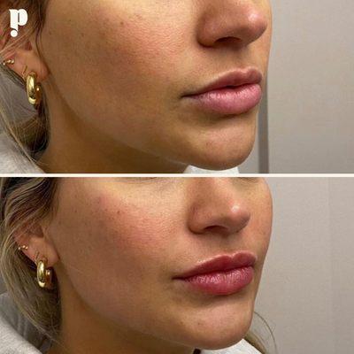 Lip Filler Treatment