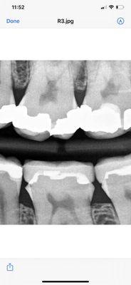 Bottom middle tooth and the one to its right are what we are focusing on.