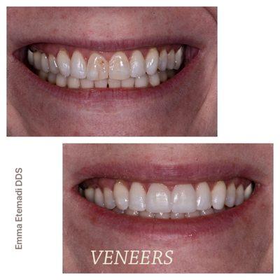 Veneers and cosmetic treatment