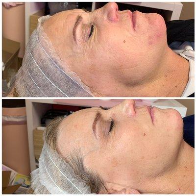 microneedling series of 3!