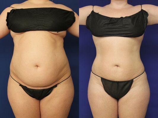 VASER Liposuction of the abdomen, waist and hips.