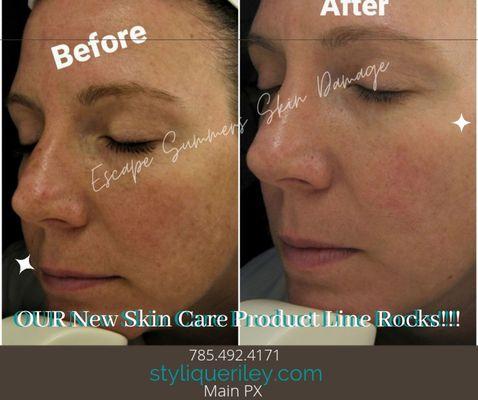 Chemical Peels available here