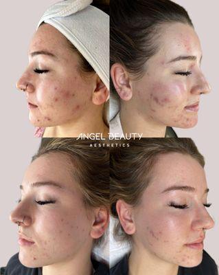 Before after acne treatment