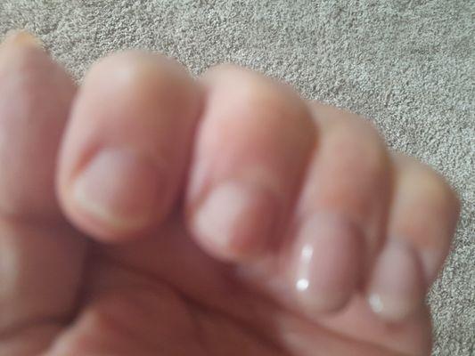 2 first nails completely gone