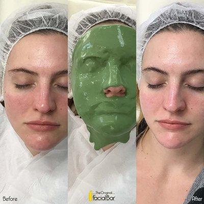 Skin Filter mask helps to tighten the pores and reduced the redness on her skin. It is much calmer and hydrated after.