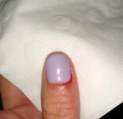 One of my finger that get a cut and bleeding