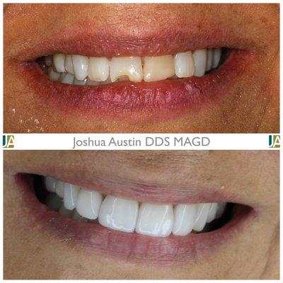 Porcelain veneers can make your smile more youthful!