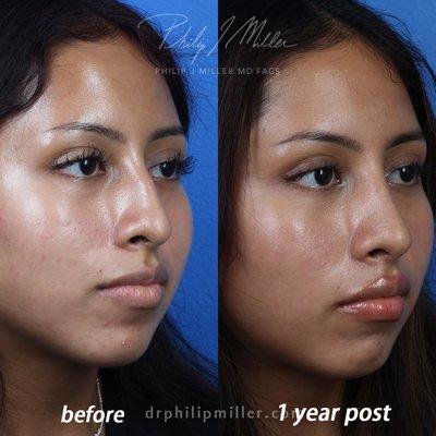 Rhinoplasty, before and after.