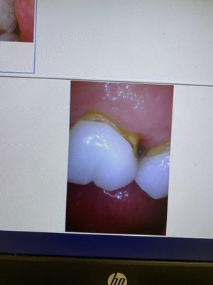 This is a year after having these crowns and they were ill fitted and now decaying.