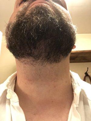 Red marks left from clippers and clearly not well done with the straight-razor. And look at all the stranglers!  What is this guy thinking?