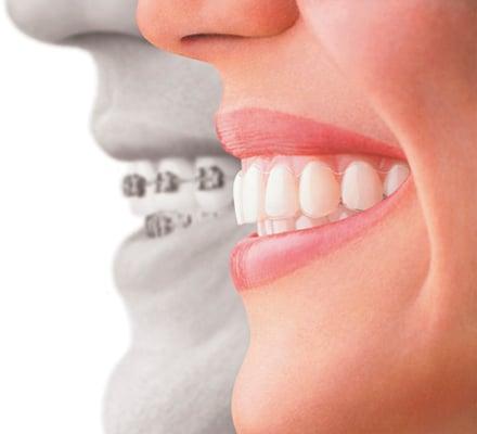 Invisalign Clear Braces versus traditional braces