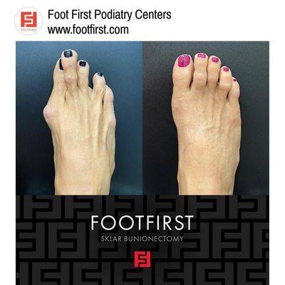 Checkout our Instagram @footfirstpod to see how we get a foot from point A to B with no cast, crutches or visible scarring!