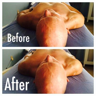 This client had 3 sessions and his right shoulder is able to have much greater ROM and no more tingling or numb hands!