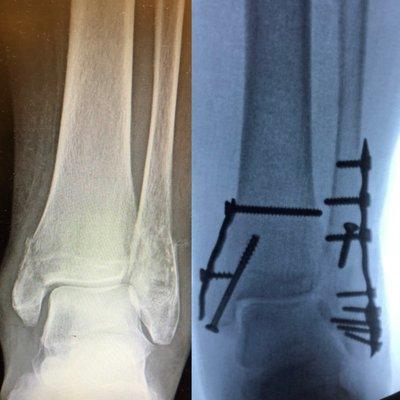 Ankle Fracture