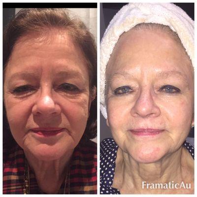 Before and after Microneedling. 4th session. Wrinkles reduced,  skin tightened and rejuvenated.