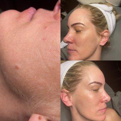 Dermaplaning before & after