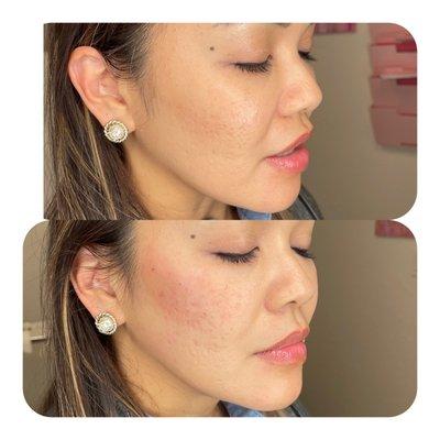 Cheek Augmentation