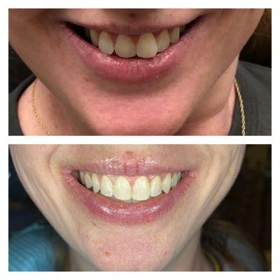 After 14 months of Invisalign, patient we were able to expand this patient's arch and give them a wider and fuller smile.