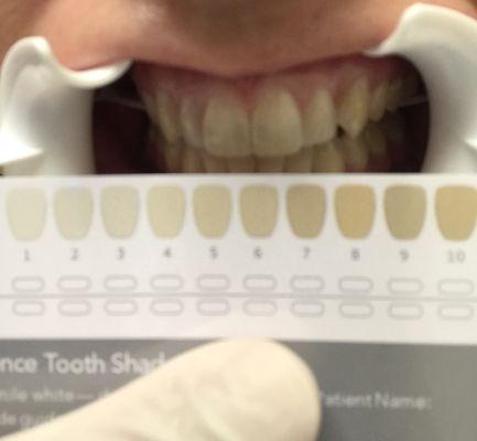 This is the initial photo of my teeth before the whitening I was a number 6-7 on the chart.