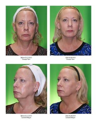 Joan P - Non-surgical face lift, after 4 weeks